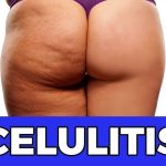 Elimina la Celulitis de Forma Natural: Estrategias Efectivas para una Piel Más Firme